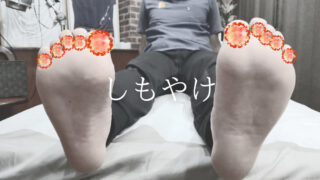 しもやけ