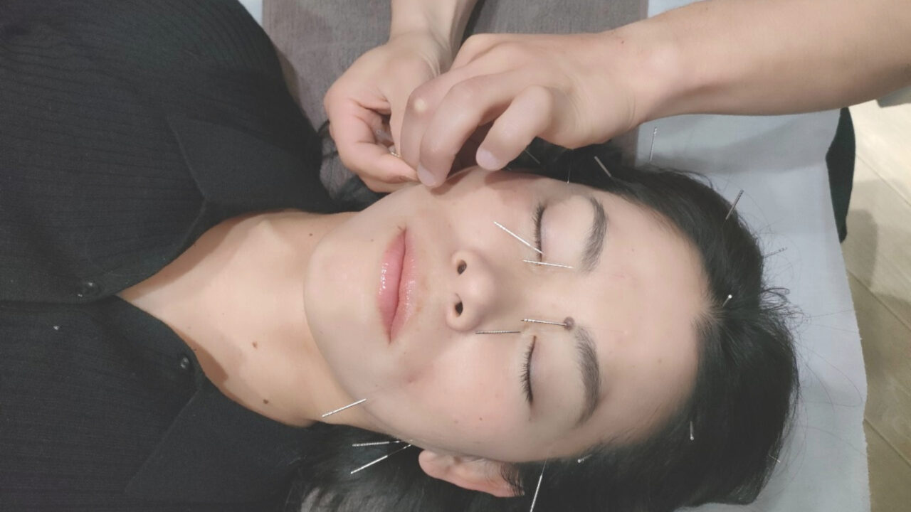 美容鍼